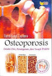 Osteoporosis (Deteksi Dini, Penanganan dan Terapi Praktis)
