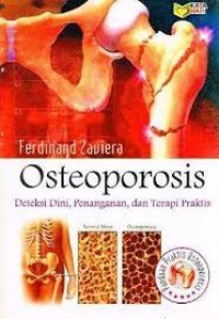 Osteoporosis Deteksi Dini, Penanganan, dan Terapi Praktis